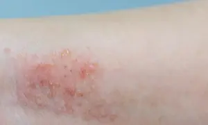Skóra z zaczerwienieniem i pęcherzykami, objawy pododermatitis.