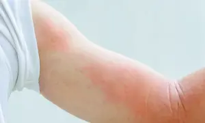 Czerwona wysypka na ramieniu, która może być reakcją alergiczną. Zastanawiasz się, po jakim czasie wychodzi uczulenie na psa?
