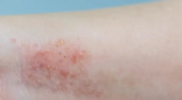 Skóra z zaczerwienieniem i pęcherzykami, objawy pododermatitis.