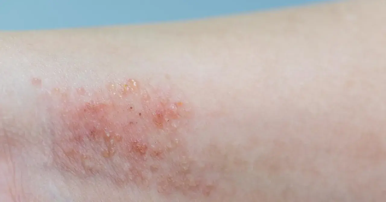 Skóra z zaczerwienieniem i pęcherzykami, objawy pododermatitis.