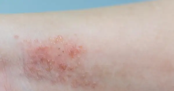 Skóra z zaczerwienieniem i pęcherzykami, objawy pododermatitis.